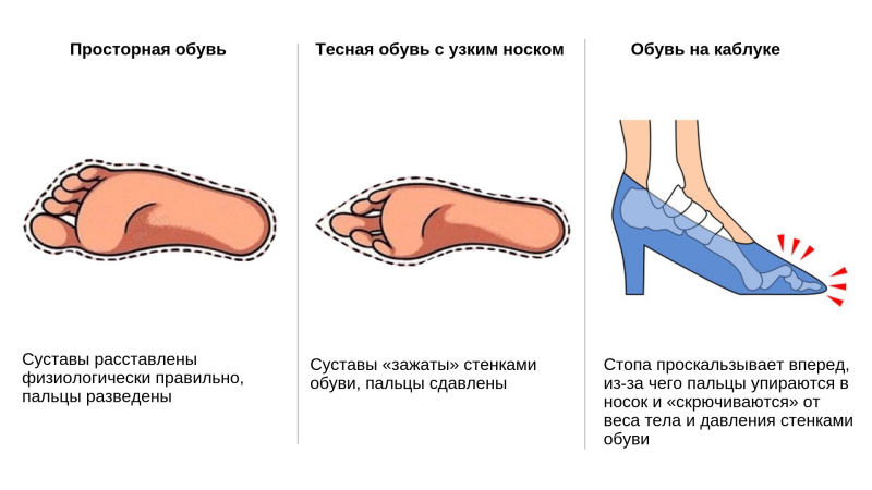 Тесная обувь