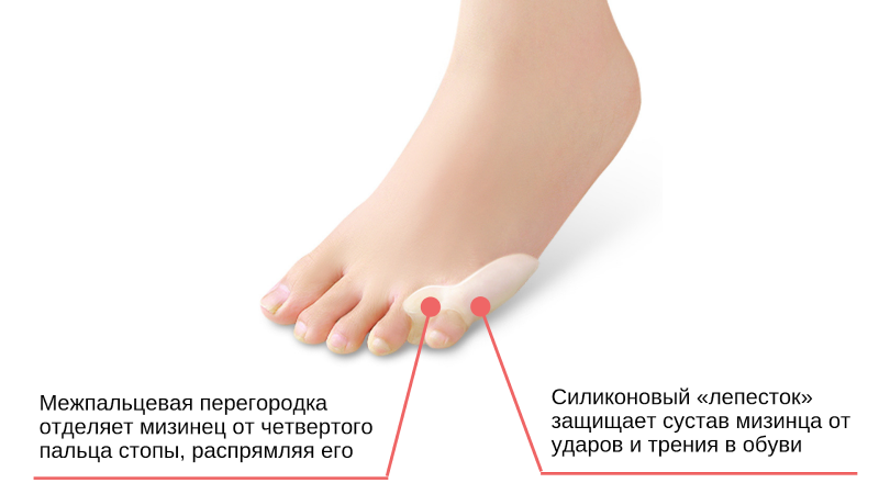 Воспаление большого пальца стопы