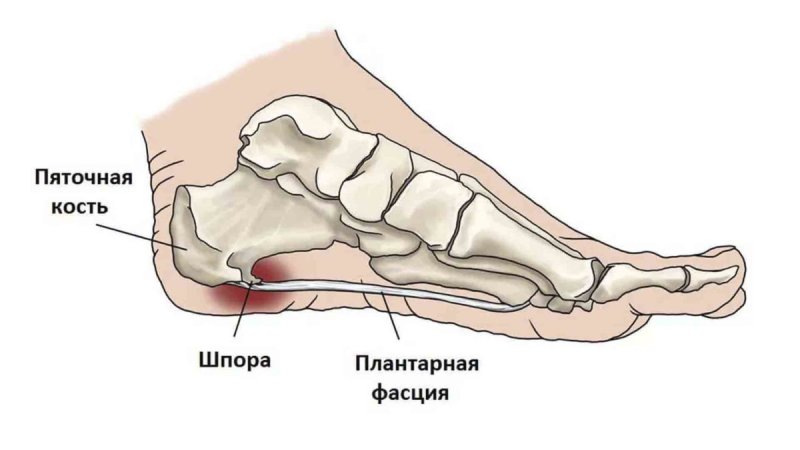 Пяточная шпора плантарный фасциит