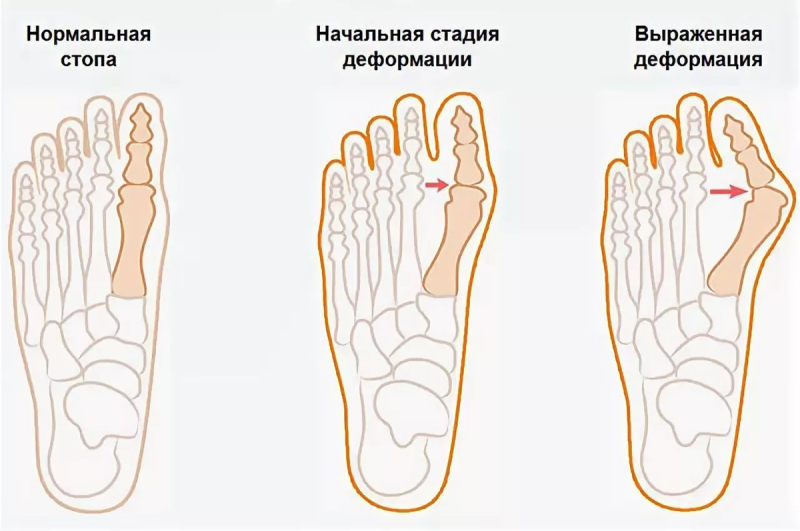 Поперечное плоскостопие вальгус