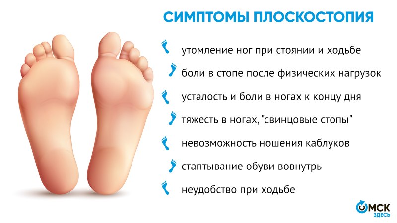 Развитие плоскостопия симптомы